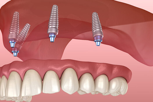 All on Four Implant in Turkey