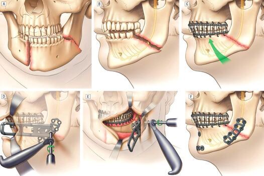 Chin Implant in Turkey 2023