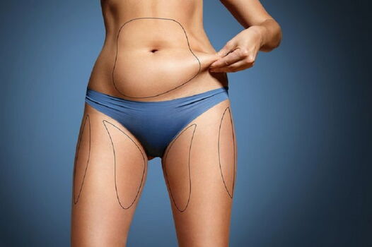 Liposuction in Turkey 2023