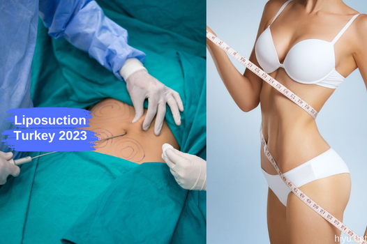 Liposuction in Turkey 2023: Affordable and High-Quality Options