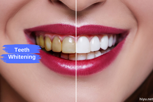 Brighten Your Smile with Teeth Whitening in Turkey 2024 (The Best Guide)
