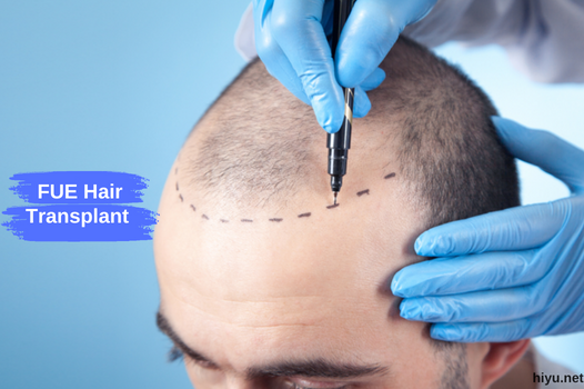 Trasplante de cabello FUE en Turquía 2023: el mejor e ideal destino para la restauración del cabello
