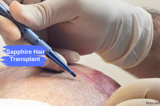Sapphire Hair Transplant in Turkey 2023: The Best and New Guide
