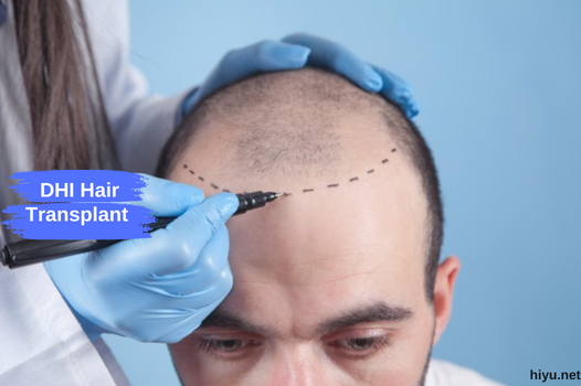 DHI Hair Transplant in Turkey 2023 (The Best and New Info)