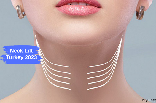 Neck Lift in Turkey 2023 (The Best Guide)