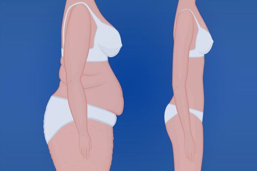 Is Weight Loss Surgery in Turkey Safe?