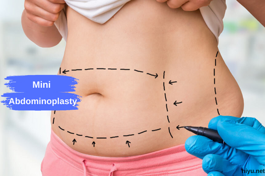Discover the Magic of Mini Abdominoplasty in Turkey 2023
