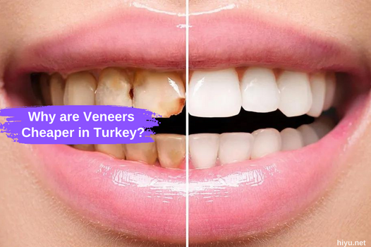 Why Are Veneers Cheaper in Turkey 2023: Your Ultimate Guide to the Best Dental Care