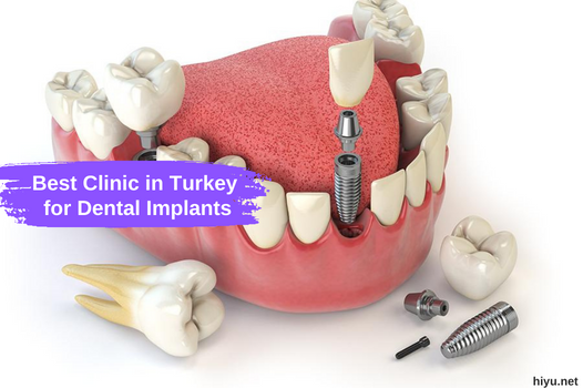 Best Clinic in Turkey for Dental Implants 2023