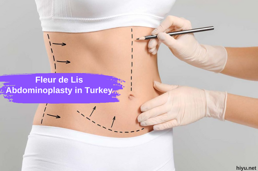 Fleur de Lis buikwandcorrectie in Turkije 2023: de beste chirurgische revolutie in Turkije