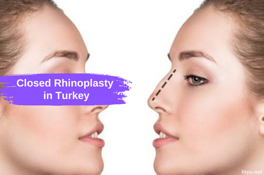 Your Final and Best Guide to Closed Rhinoplasty in Turkey 2024