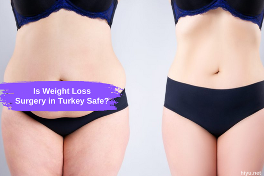 Is Weight Loss Surgery in Turkey Safe?