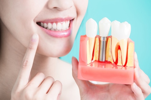 Best Clinic in Turkey for Dental Implants 2023