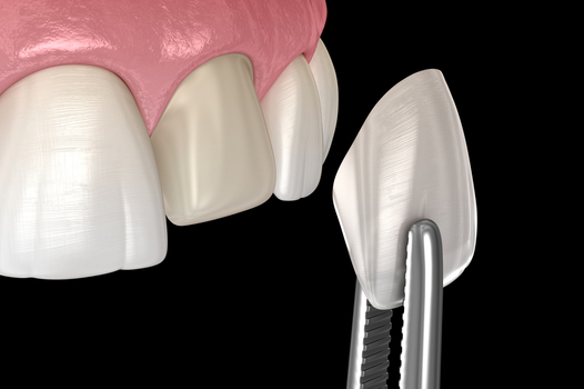 Why are Veneers Cheaper in Turkey?