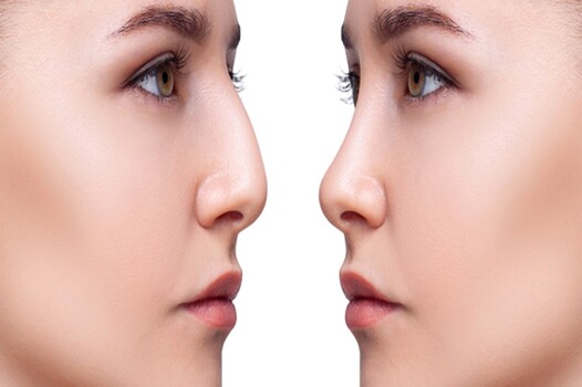 Closed Rhinoplasty in Turkey 