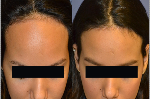 Forehead Reduction Surgery 