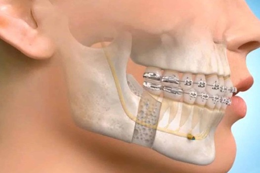 Oral and Maxillofacial Surgery in Turkey