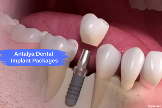 Balíčky zubních implantátů Antalya 2023: Odemkněte svůj úsměv