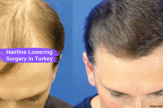 Hairline Lowering Surgery in Turkey: The Best Guide in 2023