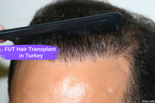 FUT Hair Transplant in Turkey: Affordable Price in Hair Restoration