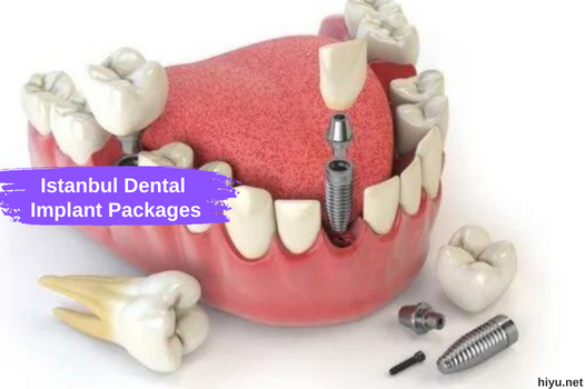 Istanbul Dental Implant Packages: Your Ultimate Guide to a Perfect Smile 2023