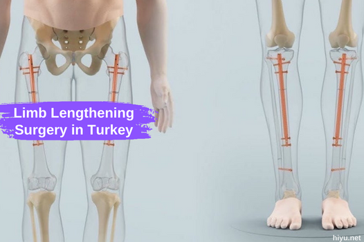 Limb Lengthening Surgery in Turkey 2024: The Ideal Solution for Increased Height