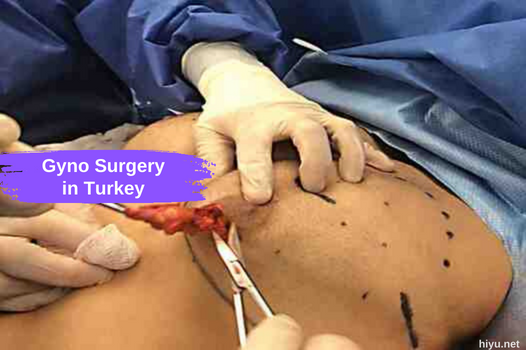 Gyno Surgery in Turkey