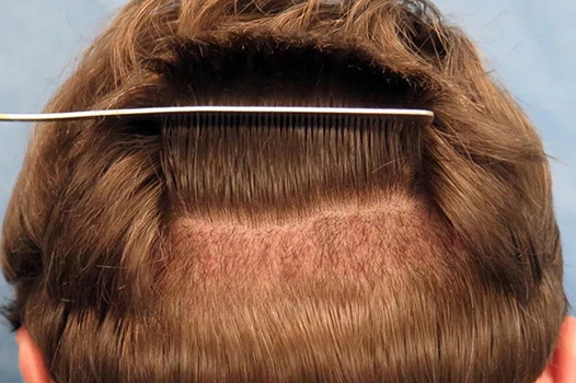FUT Hair Transplant in Turkey