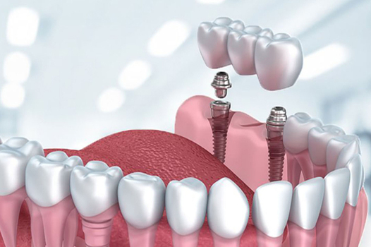 Antalya Dental Implant Packages
