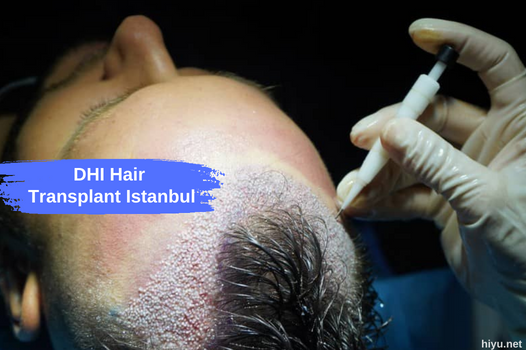 DHI Hair Transplant Istanbul: The Best Method for Hair Restoration in 2023