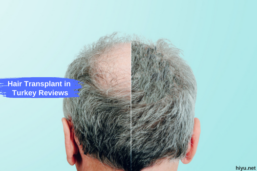 Hair Transplant in Turkey Reviews (The Best Guide for 2023)