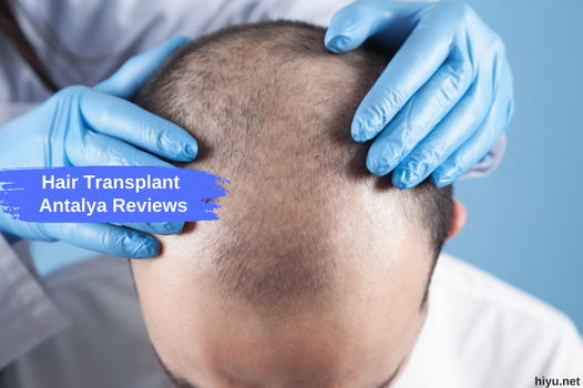 Отзиви за трансплантация на коса в Анталия (всичко, което трябва да знаете 2023)