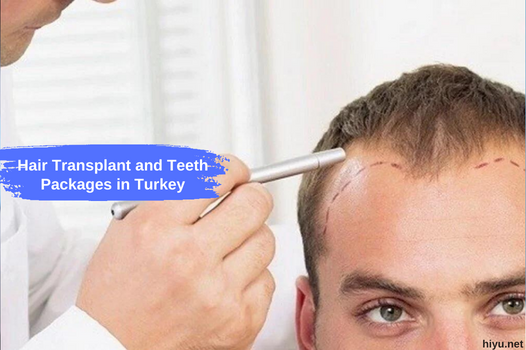 Hair Transplant and Teeth Packages in Turkey (Your Ultimate and Best Guide 2023)