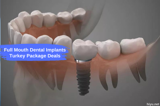 Full Mouth Dental Implants Turkey Package Deals 2023 (The Best Guide)