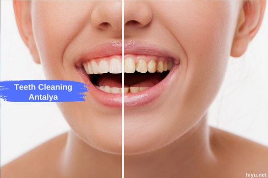 Limpieza dental Antalya 2023: su mejor guía para una sonrisa más brillante en el paraíso mediterráneo