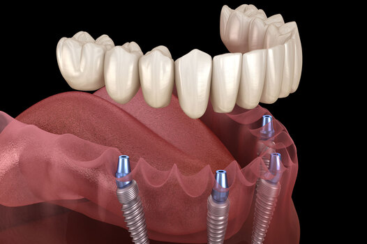 Зъбни импланти за цяла уста Турция Пакети