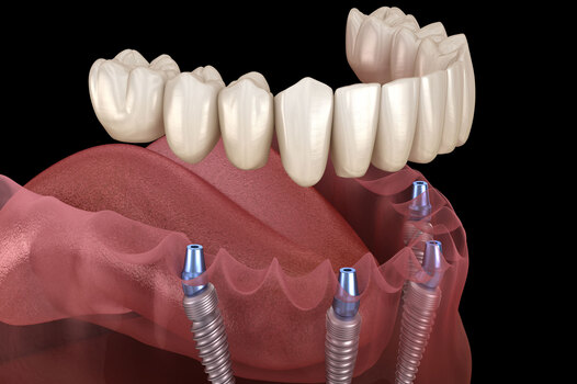 Full Mouth Dental Implants Turkey Package Deals