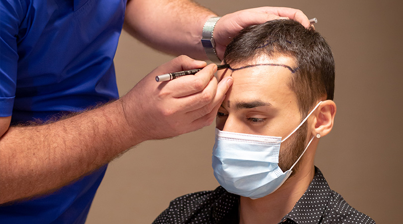 Ползите от трансплантацията на коса за възстановяване на косопада